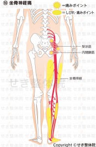 坐骨神経痛