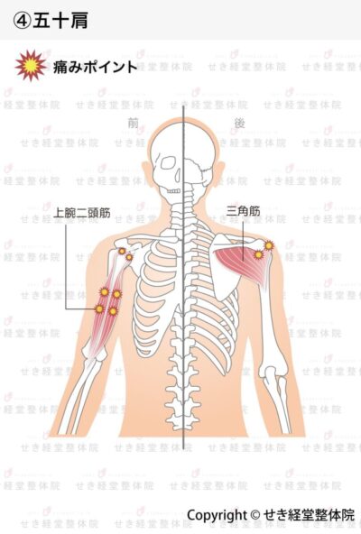 五十肩、四十肩（肩関節周囲炎）