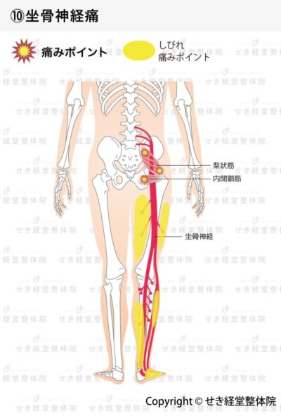 坐骨神経痛