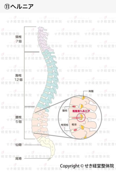 椎間板ヘルニア