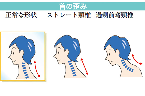 首の歪み