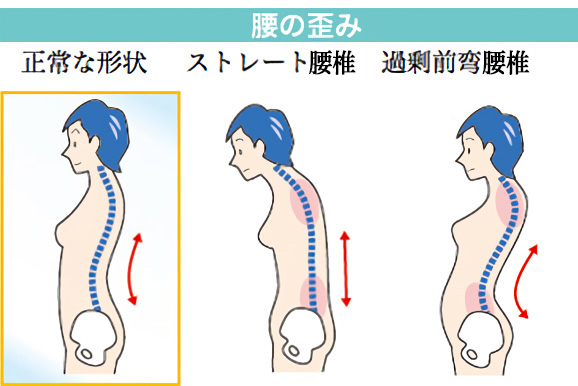 腰の歪み